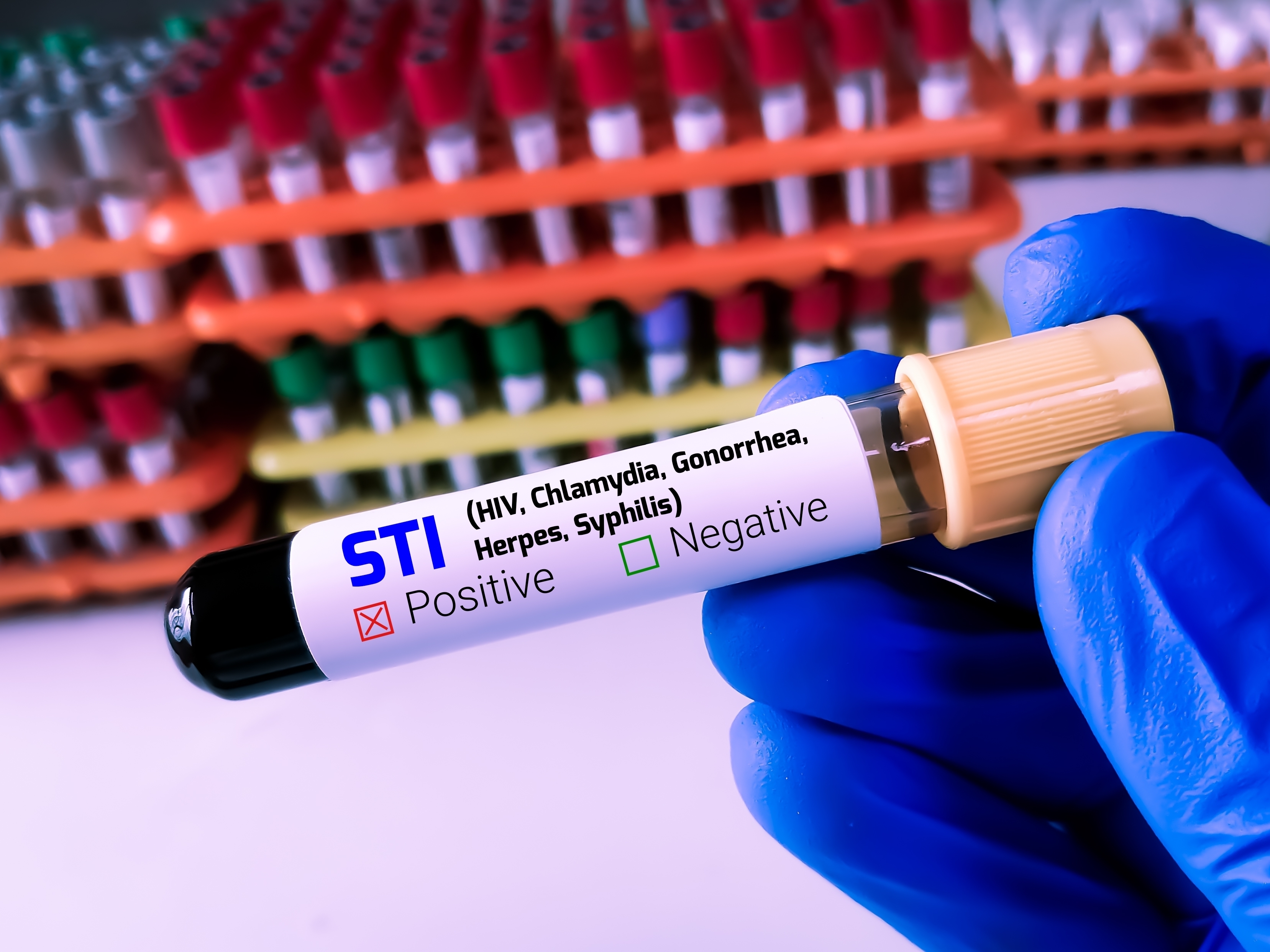 Biochemist,Or,Lab,Technologist,Holds,Blood,Sample,For,Sti,Or