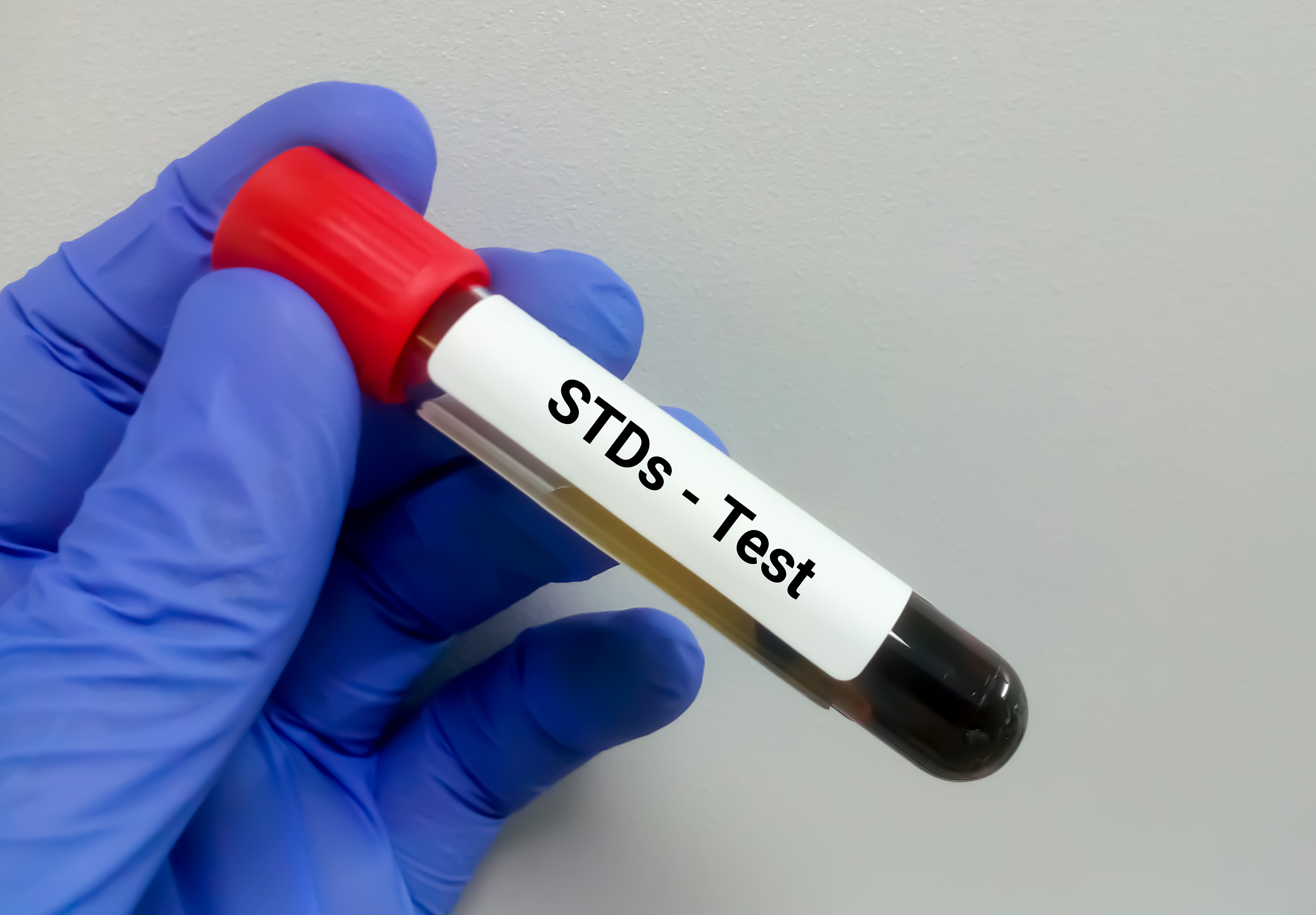 Blood,Sample,For,Stds,(sexually,Transmitted,Diseases),Test
